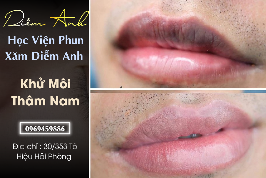 Che đo cham soc sau khi khu tham moi nam tai Hai Phong