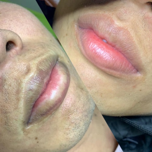 uu điem khi xu ly moi tham tai phun xam Diem Anh