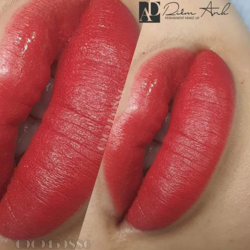 phun moi collagen dep tai hai phong